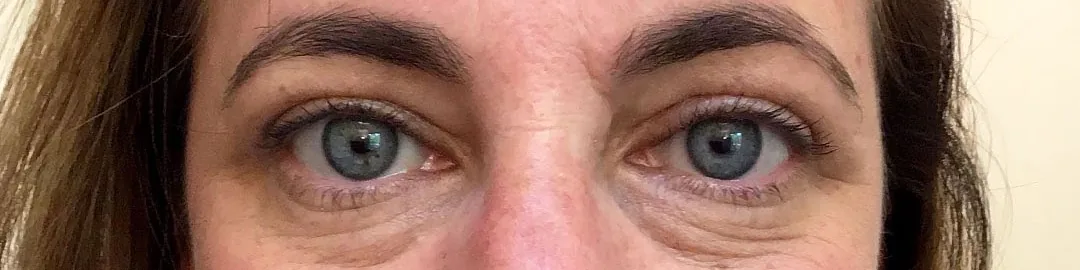 After — Botox Brow Lift, actual patient of Dr. John J.W. Lee