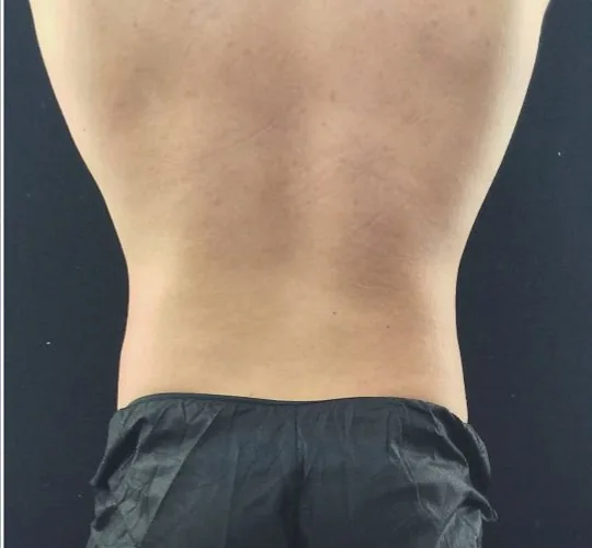 After — CoolSculpting, actual patient of Dr. John J.W. Lee