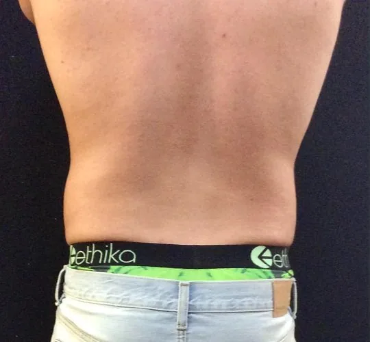 Before — CoolSculpting, actual patient of Dr. John J.W. Lee