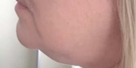 Before — Kybella, actual patient of Dr. John J.W. Lee