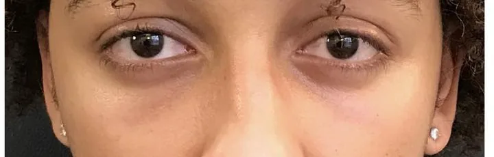 After — Lower Eyelid Surgery, actual patient of Dr. John J.W. Lee