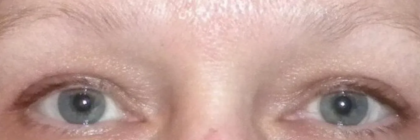 After — Ptosis Repair, actual patient of Dr. John J.W. Lee