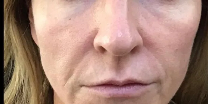 Before — Temple Mid Facelift, actual patient of Dr. John J.W. Lee