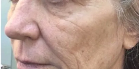 Before — Temple Mid Facelift, actual patient of Dr. John J.W. Lee