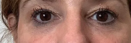 After — Facial Fillers, actual patient of Dr. John J.W. Lee