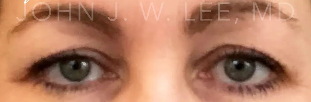 Before — Upper Eyelid Surgery, actual patient of Dr. John J.W. Lee