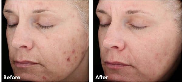 This result was achieved with the SkinMedica Vitalize peel