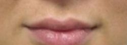 Filler Injections case #10727