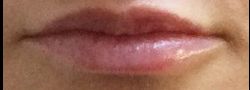 Filler Injections case #10718