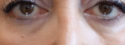 Filler Injections case #10715