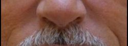 Filler Injections case #10712
