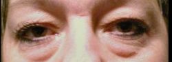 Upper Eyelid Blepharoplasty case #10851
