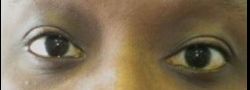 Upper Eyelid Blepharoplasty case #10911