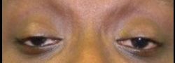 Upper Eyelid Blepharoplasty case #10911