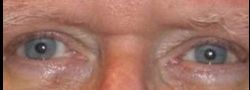 Upper Eyelid Blepharoplasty case #10908