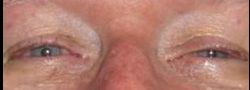 Upper Eyelid Blepharoplasty case #10908