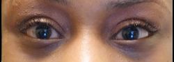 Upper Eyelid Blepharoplasty case #10854