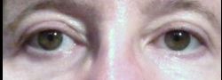Upper Eyelid Blepharoplasty case #10866