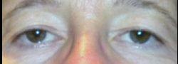 Upper Eyelid Blepharoplasty case #10866