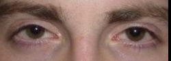 Upper Eyelid Blepharoplasty case #10869