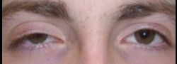 Upper Eyelid Blepharoplasty case #10869