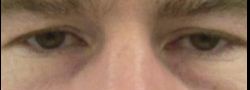 Upper Eyelid Blepharoplasty case #10872