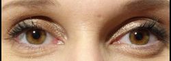 Upper Eyelid Blepharoplasty case #10887