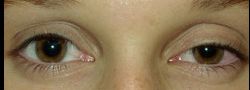 Upper Eyelid Blepharoplasty case #10887