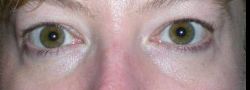 Lower Eyelid Blepharoplasty case #10807
