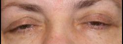 Dr. Lee’s Brow Lift case #10676
