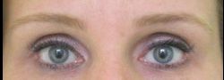 Dr. Lee’s Brow Lift case #10664
