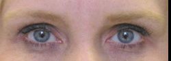 Dr. Lee’s Brow Lift case #10664