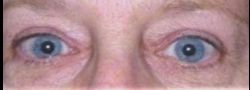 Dr. Lee’s Brow Lift case #10652