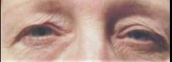 Dr. Lee’s Brow Lift case #10652
