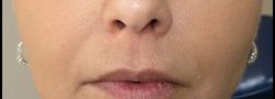 Mid Face Suture Lift case #10842