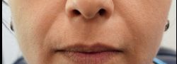 Mid Face Suture Lift case #10842