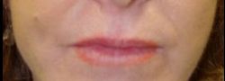 Mid Face Suture Lift case #10839