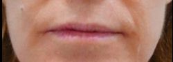 Mid Face Suture Lift case #10839
