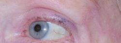 Eyelid Reconstruction case #10703