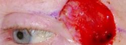Eyelid Reconstruction case #10703