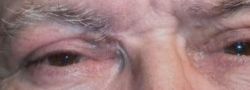 Eyelid Reconstruction case #10700