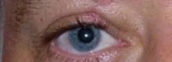 Eyelid Reconstruction case #10697