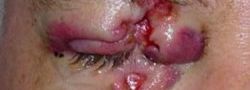 Eyelid Reconstruction case #10697