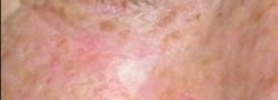 Eyelid Reconstruction case #10694