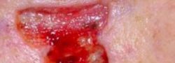 Eyelid Reconstruction case #10694