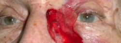 Eyelid Reconstruction case #10691