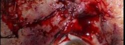 Eyelid Reconstruction case #10688