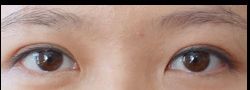 Asian Crease & Double Eyelid Surgery case #10538