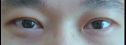 Asian Crease & Double Eyelid Surgery case #10544