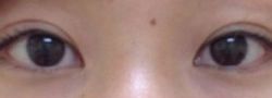 Asian Crease & Double Eyelid Surgery case #10547